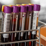 Polycytemia vera – symtom, orsak, behandling